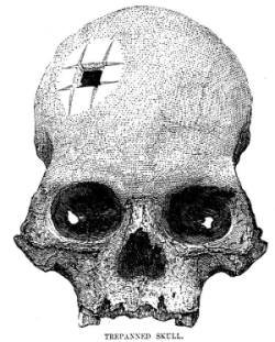 Trepanning-Pt2A