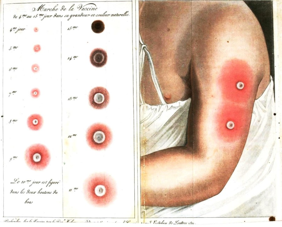 smallpox lesions